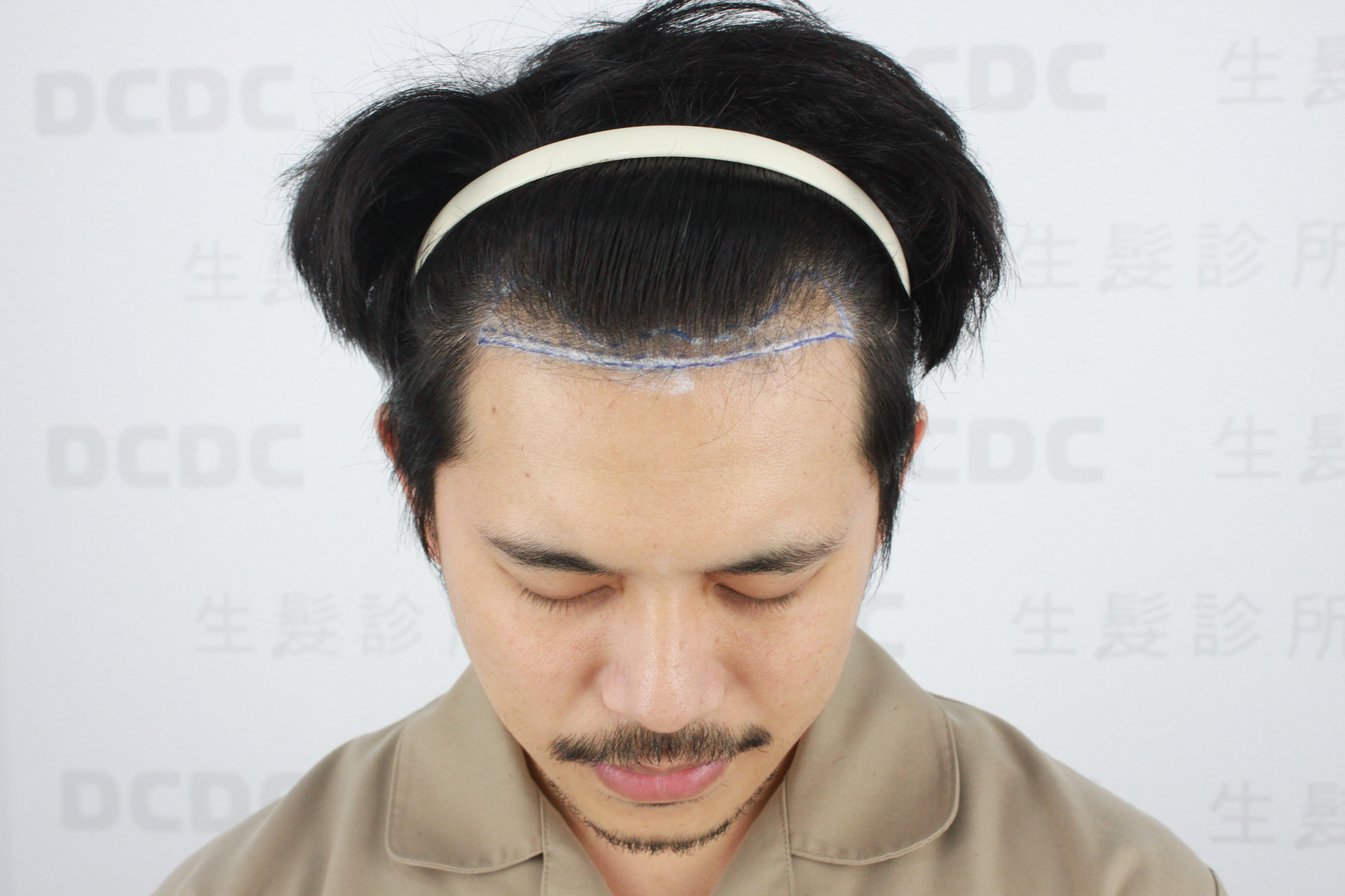 DCDC生髮診所-黃于甄醫師雄性禿M型髮際線植髮術前評估
